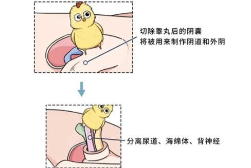 睪丸切除術(shù),臥床時間,泰國曼谷雨整形醫(yī)院,陰道再造技術(shù),術(shù)后注意事項