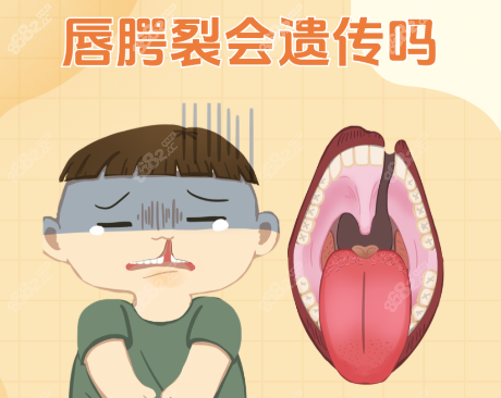 唇腭裂二次修复手术,2025年,医院,医生团队,技术原理