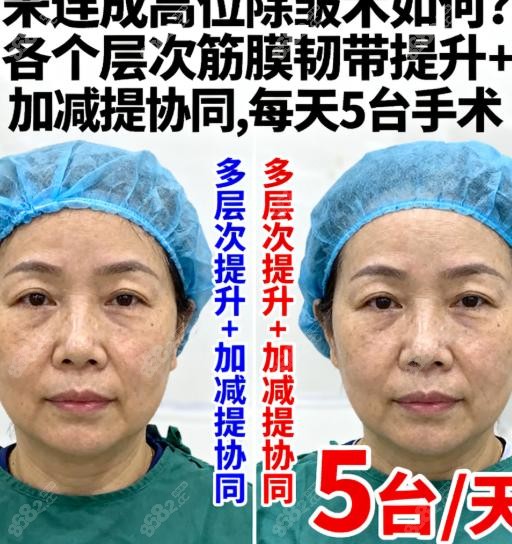 宋连成高位除皱术如何定制化切口+内窥镜