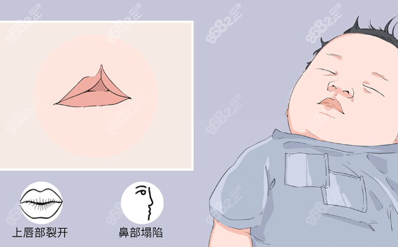 唇腭裂二次修复手术,2025年,医院,医生团队,技术原理