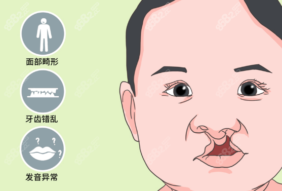 唇腭裂二次修复手术,2025年,医院,医生团队,技术原理