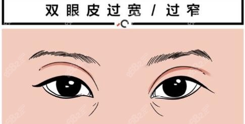 上海华美,佀同帅,双眼皮,多层组织复位技术,三阶去皮去脂法,双眼皮修复,价格