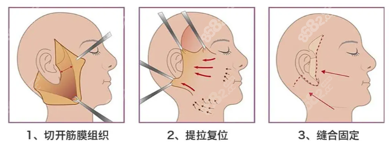 韓國muly整形醫(yī)院拉皮價格：6.8W拿下媽生感緊致，動態(tài)表情自然不僵硬
