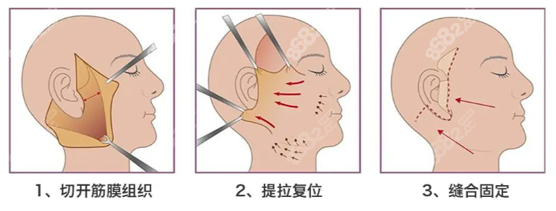 韓國(guó)muly整形醫(yī)院拉皮實(shí)例