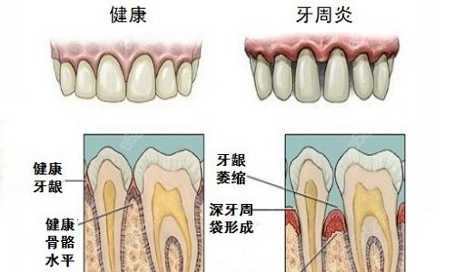 牙周炎情況展示