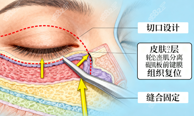 韓國雙眼皮修復(fù)避坑攻略：10家專治肉條/寬改窄的醫(yī)院閉眼選，拒收黑名單