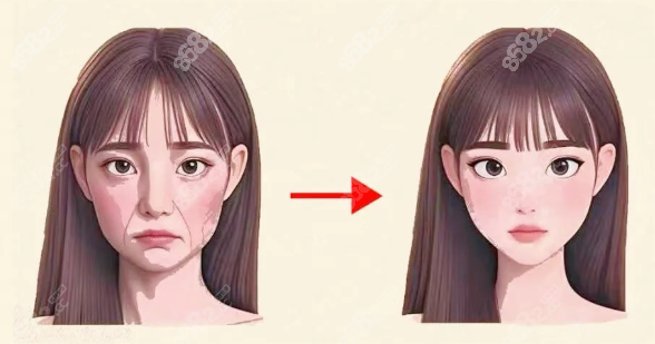韓國muly整形醫(yī)院拉皮真實(shí)實(shí)例反饋