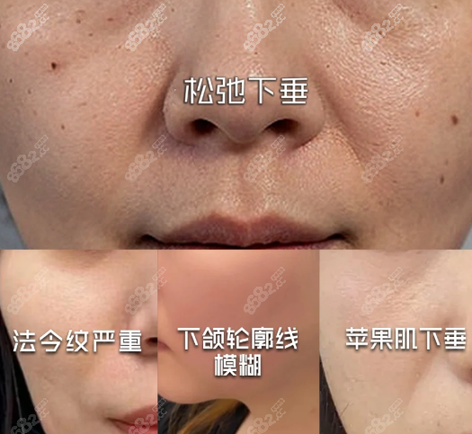 韓國(guó)muly整形醫(yī)院拉皮成效太贊！術(shù)后蘋(píng)果肌歸位，顯年輕5歲真值！