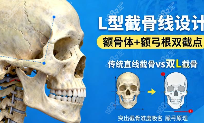 柳超颧骨颧弓采用什么方式