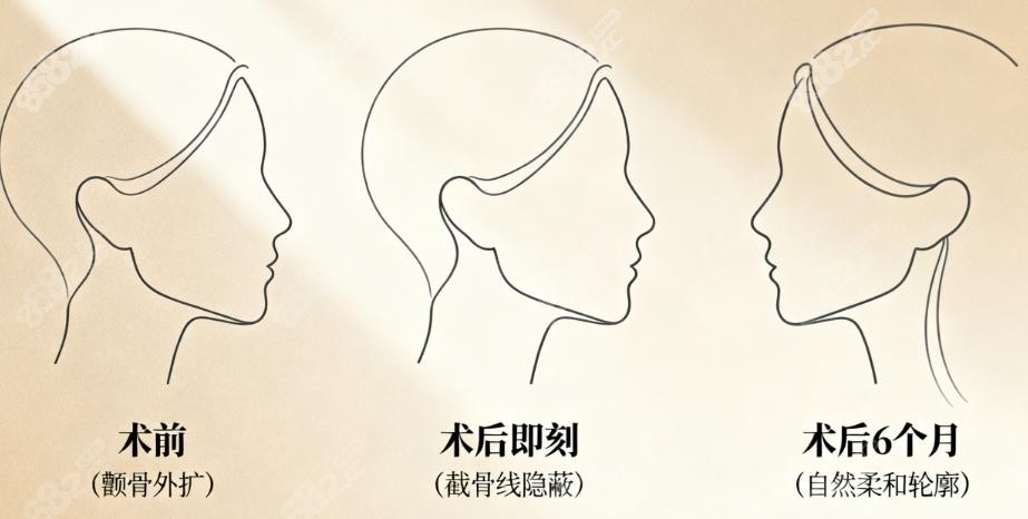 柳超颧骨内推骨缝不大