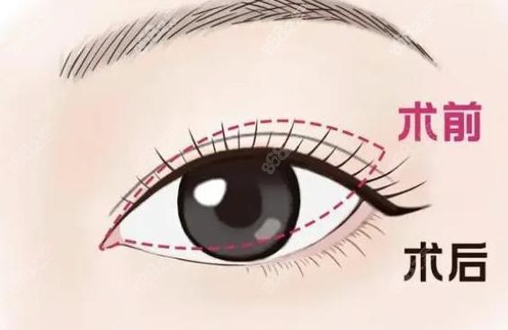 郑州王杨做双眼皮自然灵动