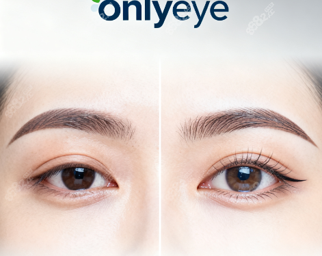 韩国onlyeye整形医院做眼修复8682.cc