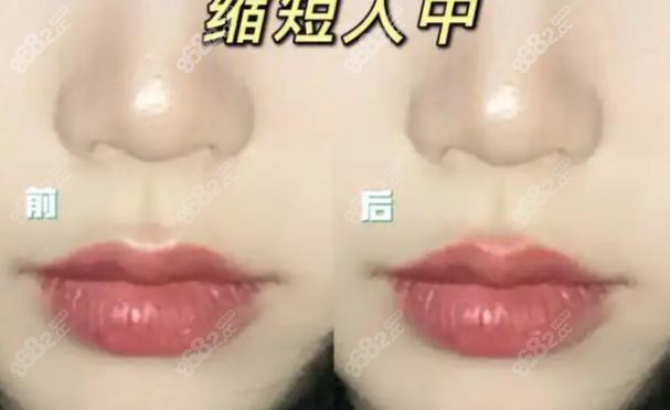 王皓民第三代人中缩短出新招啦？成效呈现惊艳众人