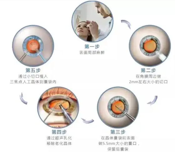 广州白内障手术价格明细www.8682.cc