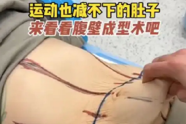 腹部拉皮手术价格一览表:约2W到8W来看SMAS腹部提升不同版本价格对比