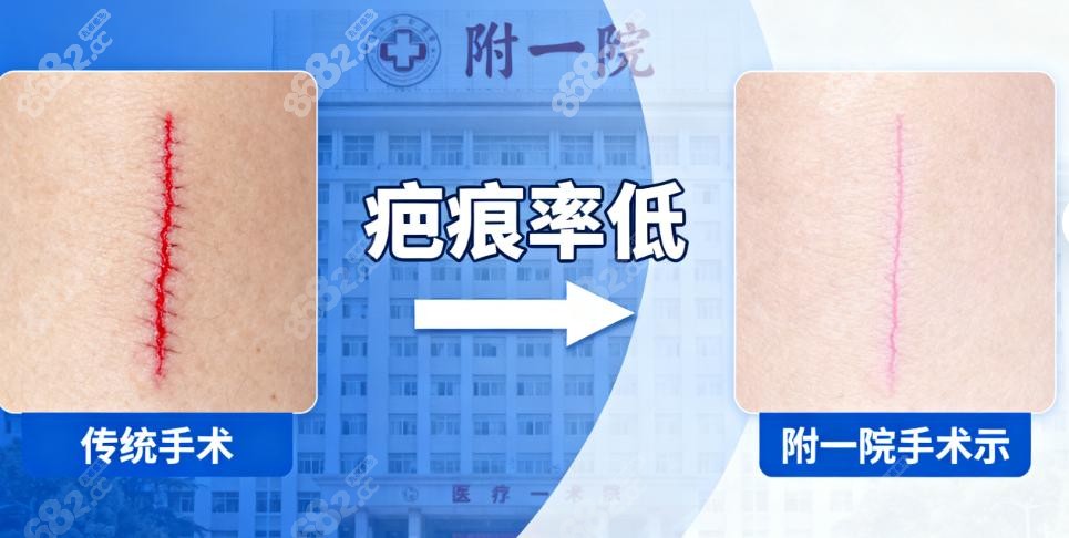 西南医院、星荣医院 vs 附一院：胸部提升各有优势，缩胸手术看附一院