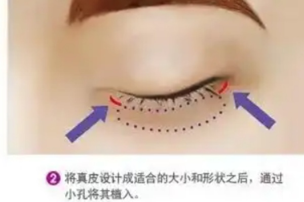 广州新市医院吕方中双眼皮价格表:12000元起擅初眼整形与修复价格透明实惠