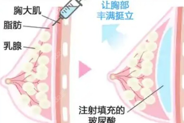 杭州凯丽ksa丰胸是骗局吗？不是骗局！看价格公开透明的优势