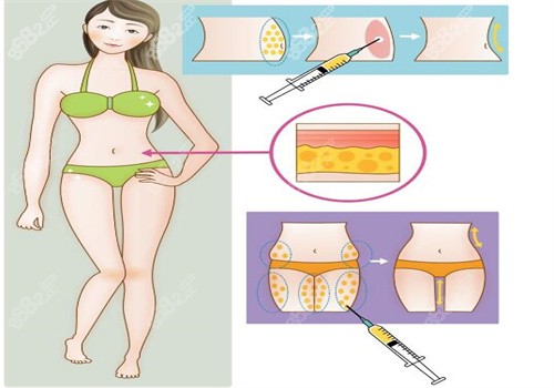 上海袁玉坤小腿吸脂