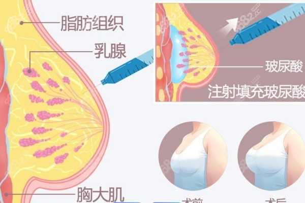 杭州凯丽ksa丰胸是骗局吗？不是骗局！看常见问题解答可靠性