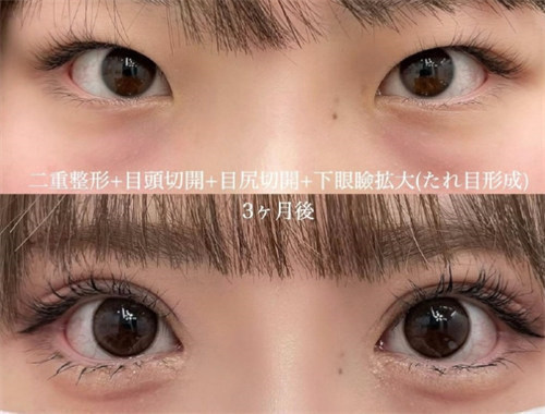 做双眼皮医生怎么选？深圳艺星/武汉卓美等医院医生技术口碑揭秘
