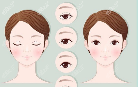 王博谦双眼皮修复技术为何如此出圈？