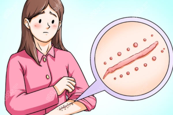 張晉寶不開(kāi)刀祛眼袋多少錢？