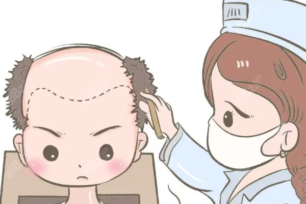 碧蓮盛植發(fā)2025價格構(gòu)成有哪些？