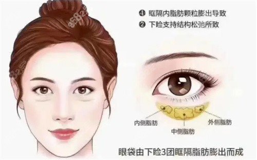 眼袋詳細介紹動畫圖 眼袋詳細介紹動畫圖