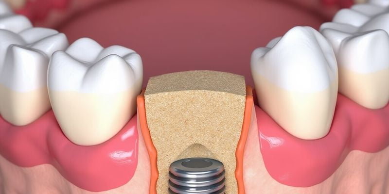 深圳一檔社保補(bǔ)牙報銷之醫(yī)院級別差異