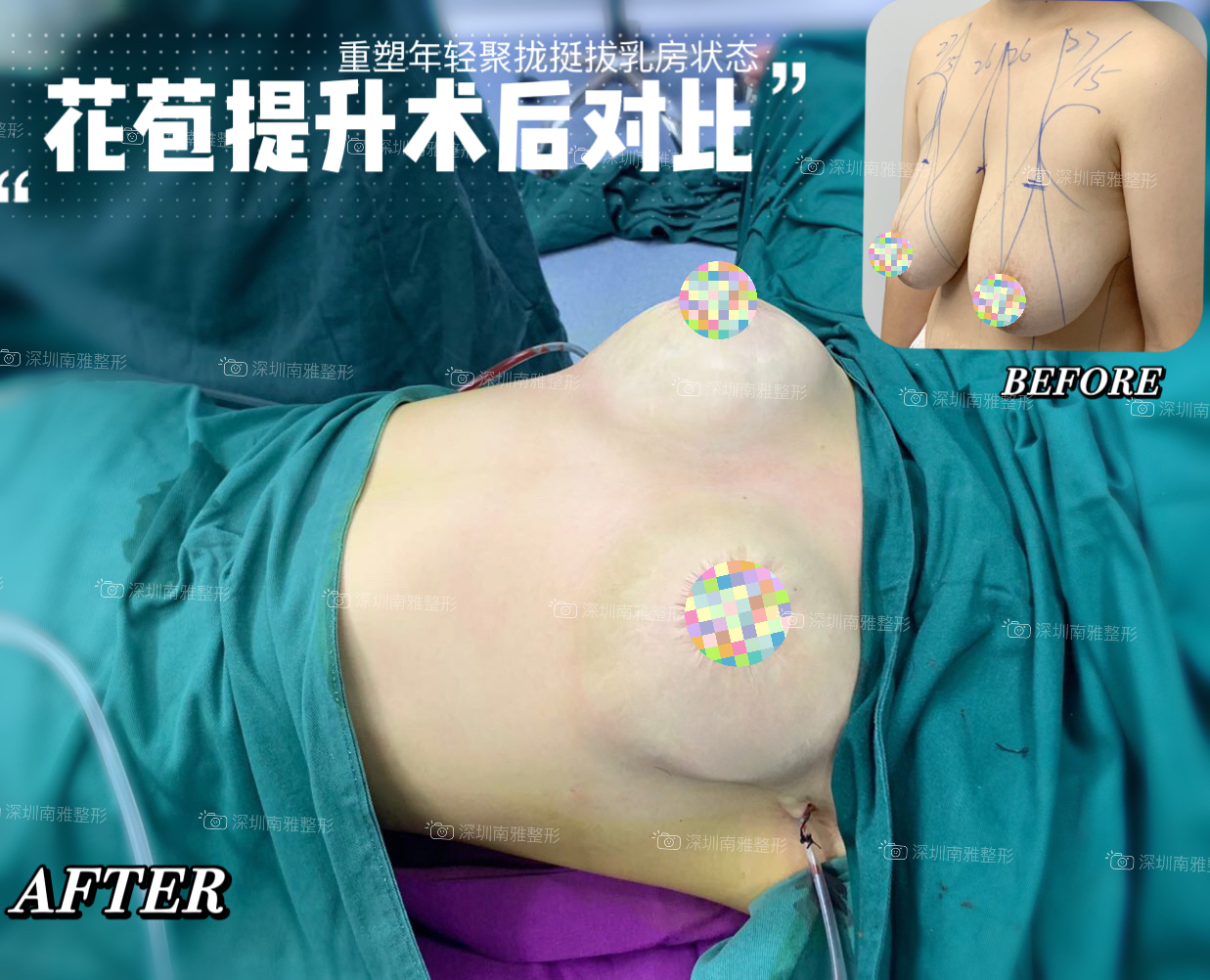 二、重庆曹勇医生隆胸情况