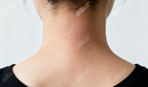 葉桐江做富貴包手術(shù)怎么樣