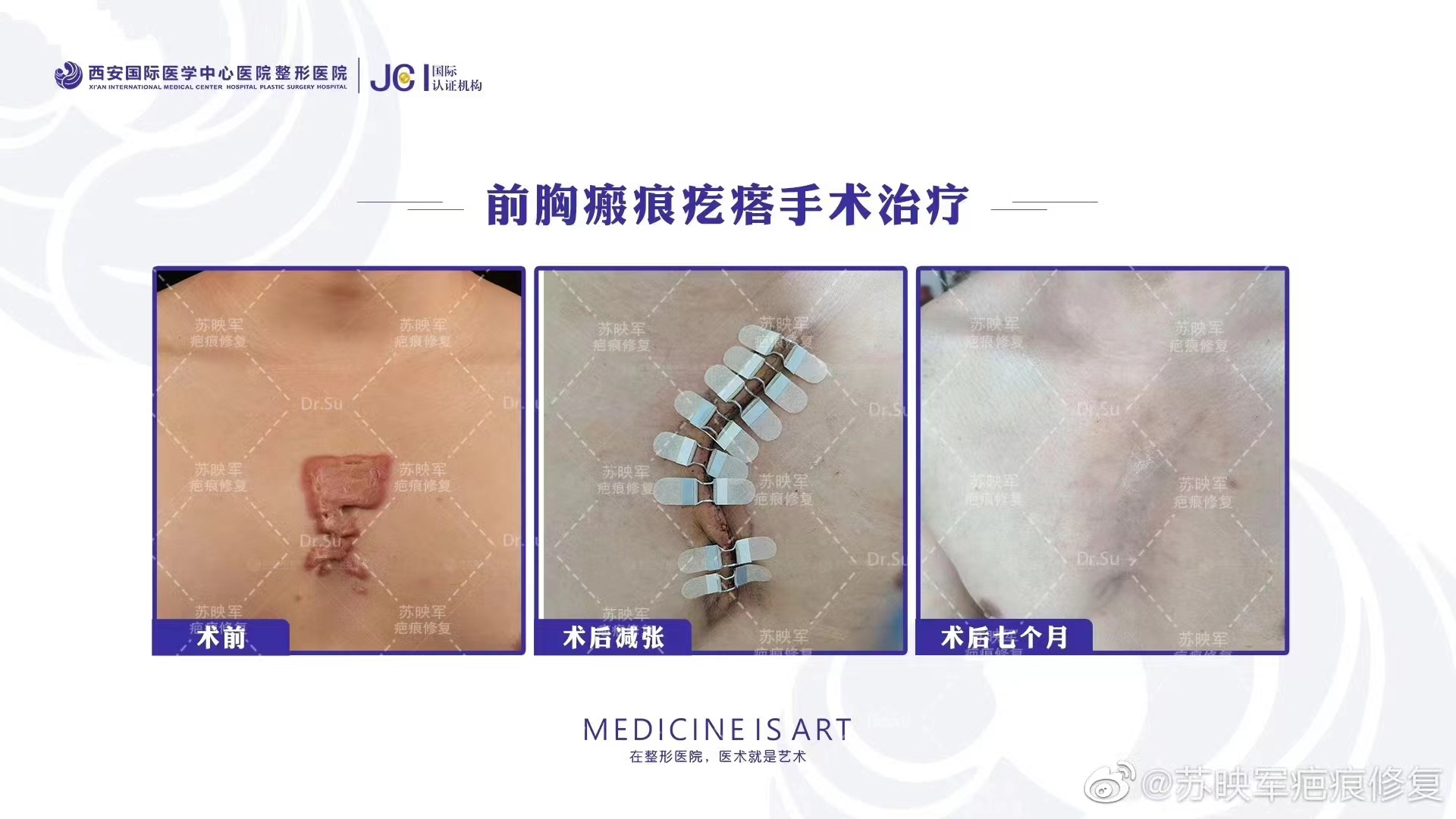 苏映军治疗疤痕贵不贵？详解价格差异原因与预算自查指南，助你选对方案！ 