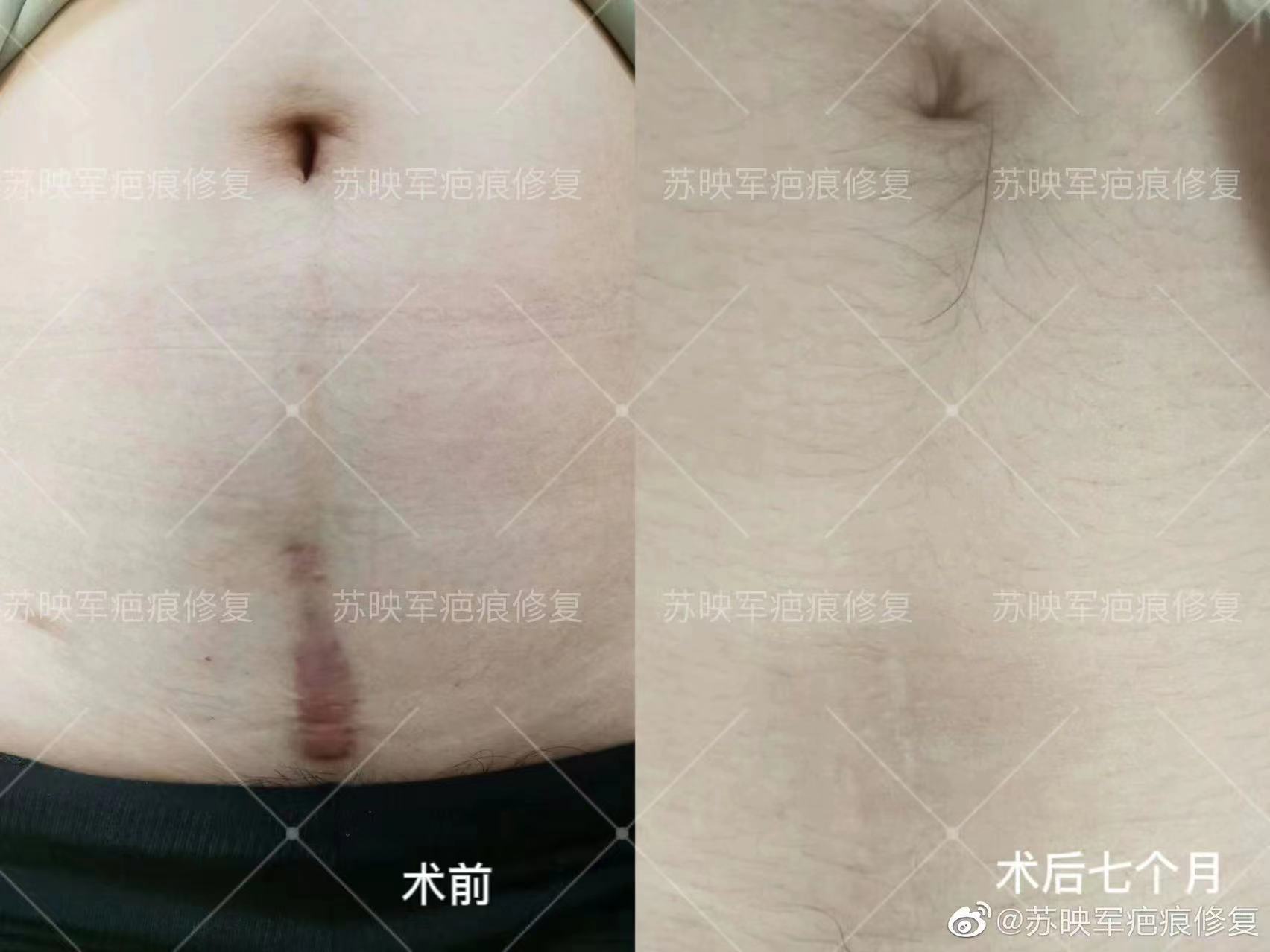 二、苏映军治疗疤痕的价格范围
