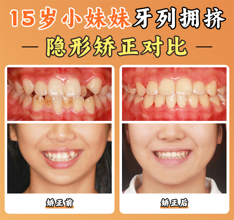 3. 牙全掉怎么辦？義齒修復(fù)了解一下（比假發(fā)還貼頭）