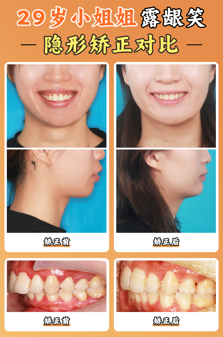 【義齒價(jià)格參考】