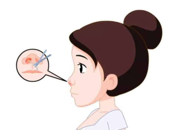 池凱醫(yī)生當下鼻整形實例展示