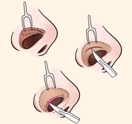 鄭州池凱醫(yī)生憑借扎實的專門功底和創(chuàng)新的鼻整形技術(shù)