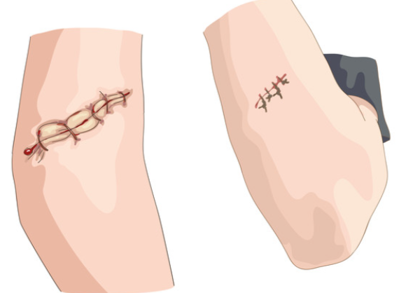 北京八大處疤痕修復(fù)價(jià)格表總結(jié)