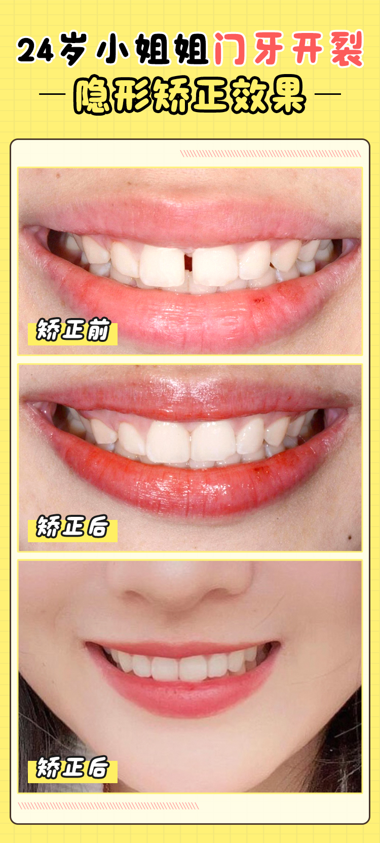 三、周彦恒临床技术大揭秘！骨性错颌非手术矫治如何做到国内外领跑？