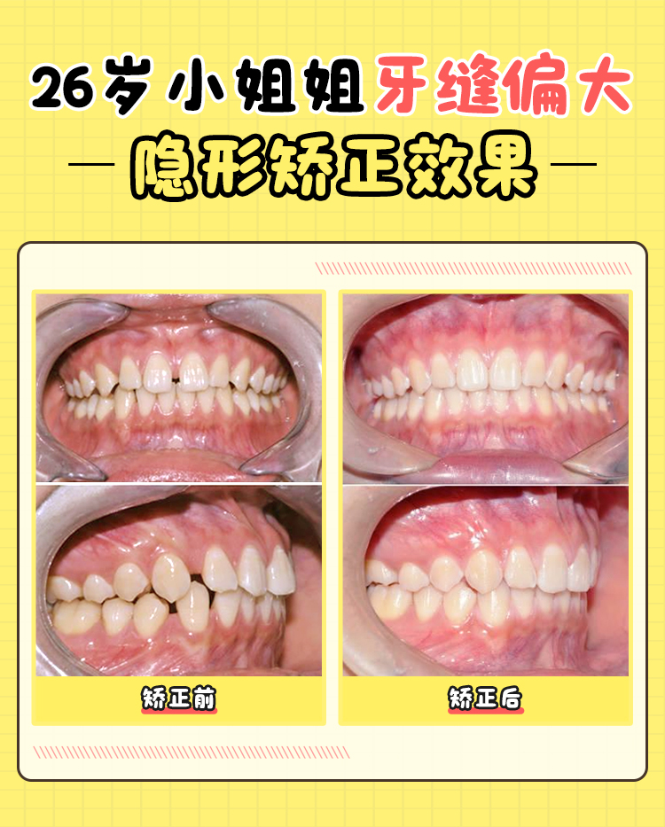 北京张栋梁医生收费价目表速览!舌侧正畸5.5万起|不拔牙矫正3.8万起,掌握数字化/舌侧等技术亮点