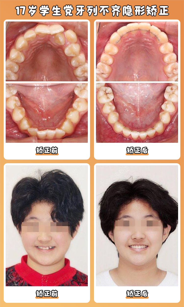 一、张栋梁医生不同矫正方式价格表总览