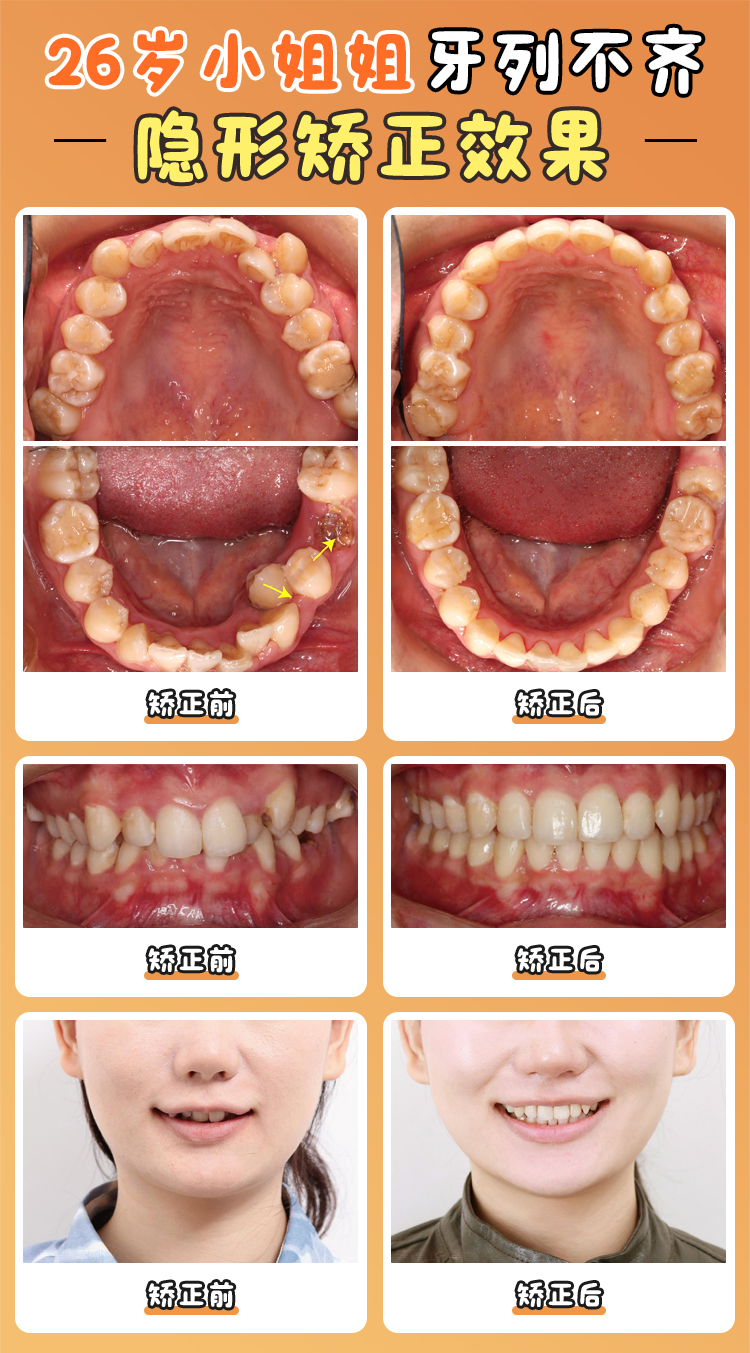 周彥恒還在北大口腔嗎？探北大正畸周彥恒骨性錯(cuò)頜正畸技術(shù)及收費(fèi)性價(jià)比