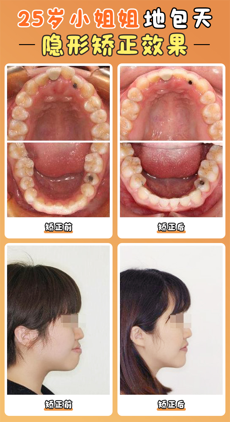 北大正畸周彥恒特別貴嗎？2025年收費(fèi)標(biāo)準(zhǔn)與性價(jià)比分析