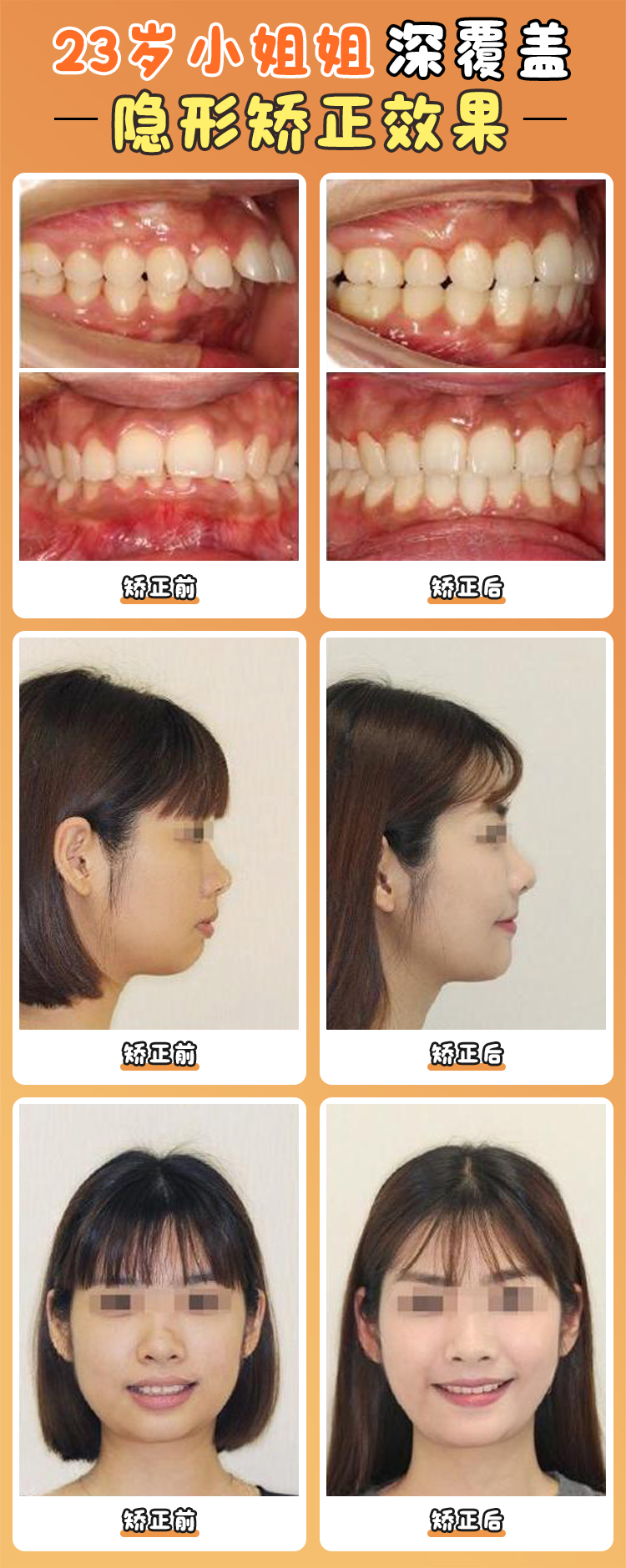 徐寶華矯正收費價目表曝光：不同技術(shù)方案的性價比之選