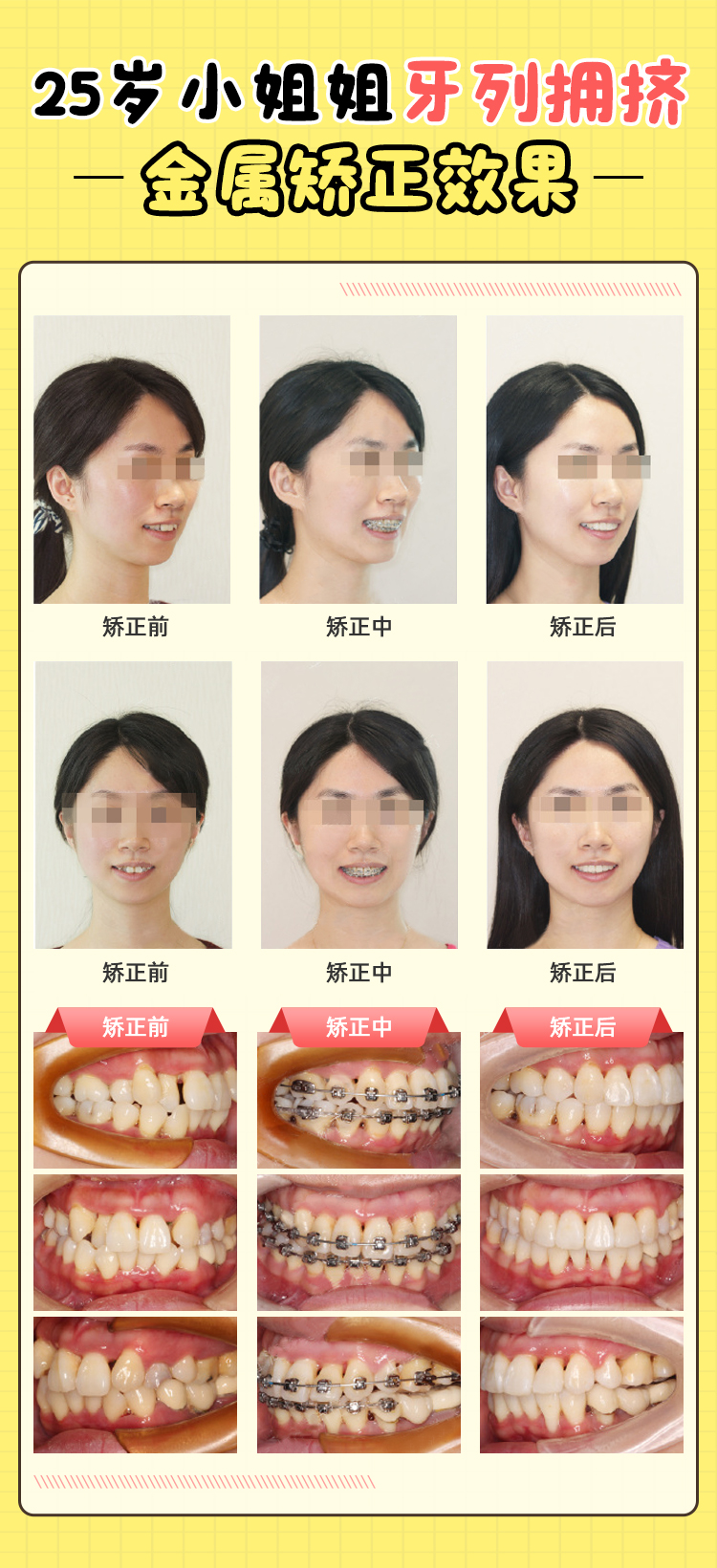 贾培增正畸案例分享:精准咬合重建+个性化弓丝方案,舌侧隐形矫正助你一年告别牙齿不齐!