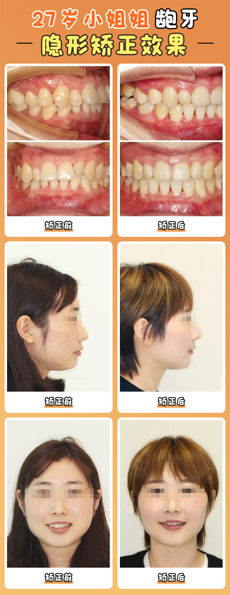 Part 5:术后变化:不止牙齿整齐,人生都像开了挂