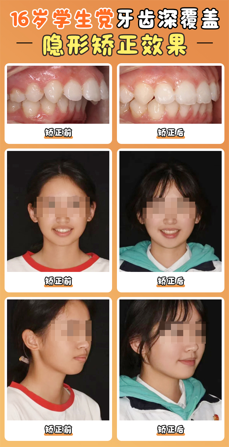 亲身揭秘张栋梁医生正畸案例！舌侧矫正+骨钉实现骨性地包天非手术矫正，面型改善惊人