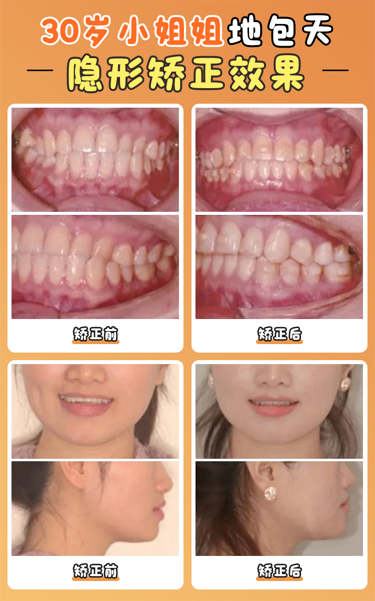 三、舌侧矫正全攻略：费用、痛感、修复期一次说清