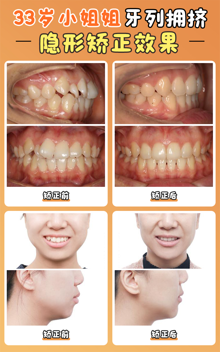 四、术后1年反馈：我妈说我像换了个女儿！
